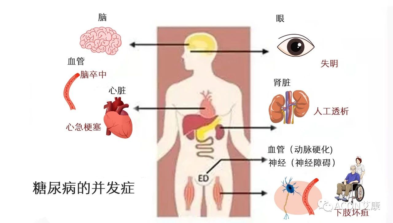 爆上熱搜，因爆發(fā)型糖尿病進(jìn)入ICU，有哪些教訓(xùn)值得我們汲取